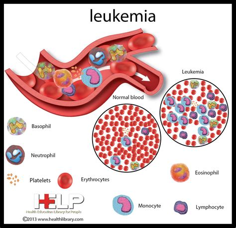 Understanding Leukemia For Kids A Simple Guide