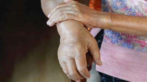 How to Reduce Hand Swelling at Home