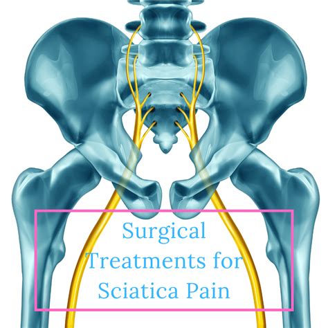 Surgery For Sciatica