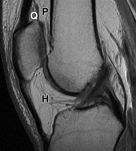 Superolateral Hoffa's Fat Pad Edema: Association With Patellofemoral Maltracking and Impingement ...