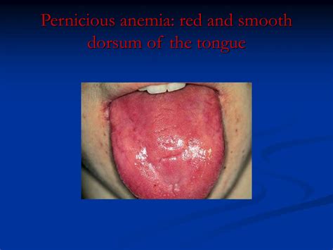 Anemia On Tongue