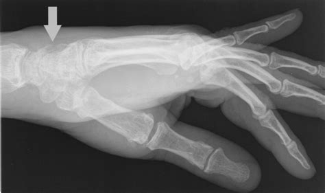 Gout Masquerading as a Triquetral Fracture | The Journal of Rheumatology