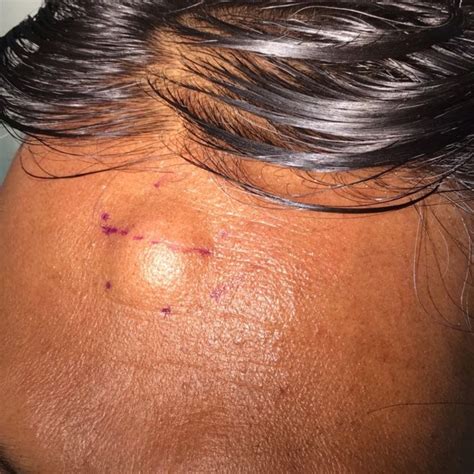 Small Forehead Lump Removal | Lipoma Excision & Scar Healing