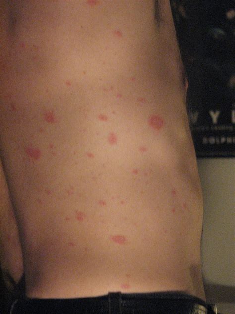Pityriasis Rosea – Pictures, Causes, Symptoms and Treatment