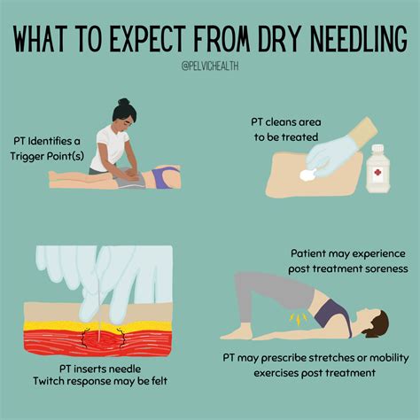 Dry Needling- How It’s Relevant To Pelvic Health