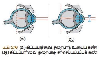 கண்ணின் குறைபாடுகள் | Defects in Eye | in Tamil