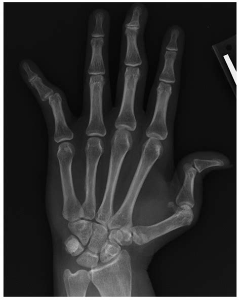 Radiographic Findings of Inflammatory Arthritis and Mimics in the Hands