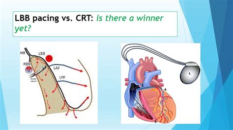 LBB pacing shows greater EF improvement than BiV-CRT in NICMP patients ...