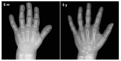 Bone Age X Ray Report at Dominique Ortega blog