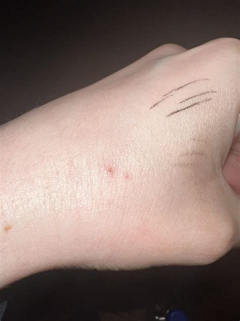 Bat Bite On Arm at James Goldsbrough blog