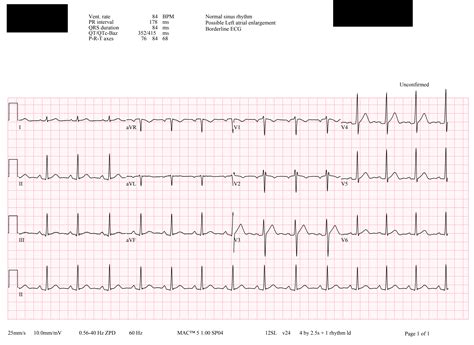 Borderline Ecg A) 12 Lead Electrocardiogram (ECG) On Presentation
