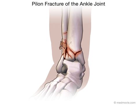 Pilon Fracture Recovery Timeline at Phillip Pusey blog