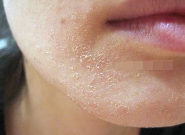 【图】脸上干燥脱皮是什么原因 4个重要因素提醒各位(3)_脸上干燥脱皮是什么原因_伊秀美容网|yxlady.com