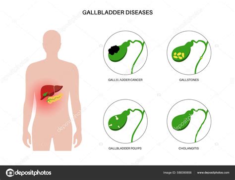 Gallbladder Diseases Infographic Gallstone Cancer Acute Cholecystitis Psc Polyps Digestive图库矢量图 ...