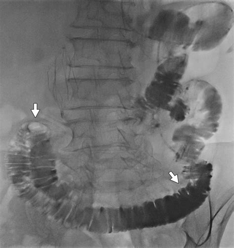 Afferent Loop Syndrome Radiology Notes Small And Large Bowel Volvulus: