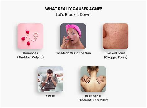 Understanding Acne: Causes, Myths & Treatments That Actually Work ...