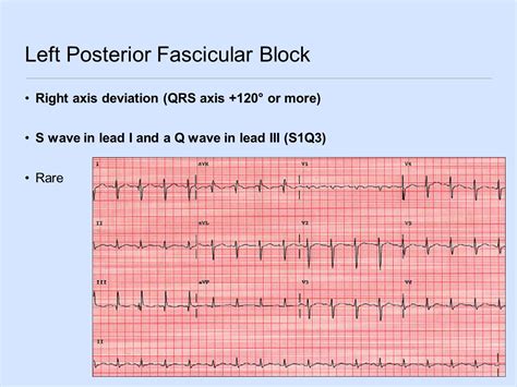 Ventricular Conduction Disturbances - ppt video online download