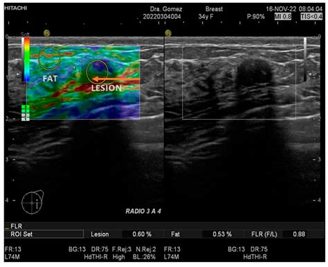 Strain Elastography Fat-to-Lesion Index Is Associated with Mammography ...