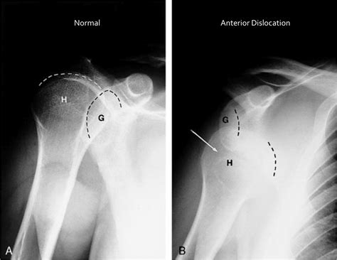 Physio Questions: Shoulder Complex (Part III) - Anterior/Posterior ...