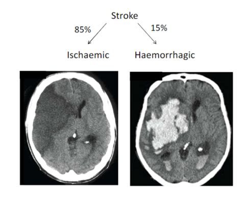 Cerebrovascular Disease Flashcards | Quizlet