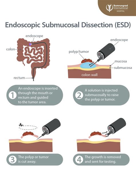 Endoscopic Submucosal Dissection: Minimally Invasive GI Care