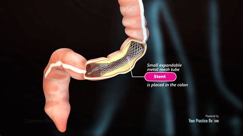 Colonic Stenting Video | Medical Video Library