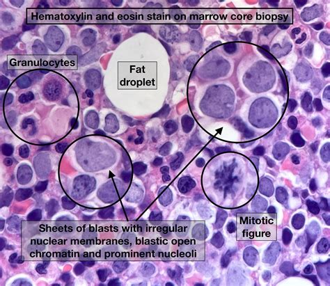 Morphologic features of Acute Lymphoblastic Leukemia (B-ALL) involving ...