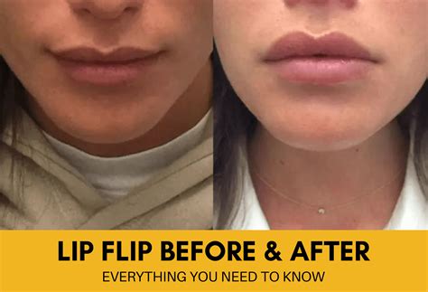 Lip Flip Botox Review at Callum Melvin blog