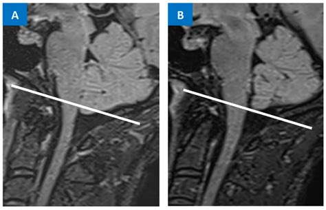 Overview of Spontaneous Intracranial Hypotension and Differential Diagnosis with Chiari I ...