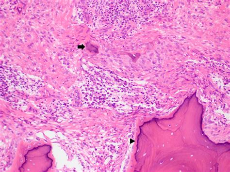 Ossifying Fibroma Oral Cavity