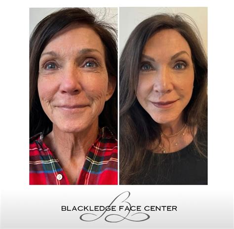 Blackledge Face Center (@blackledgefacecenter) • Instagram photos and ...