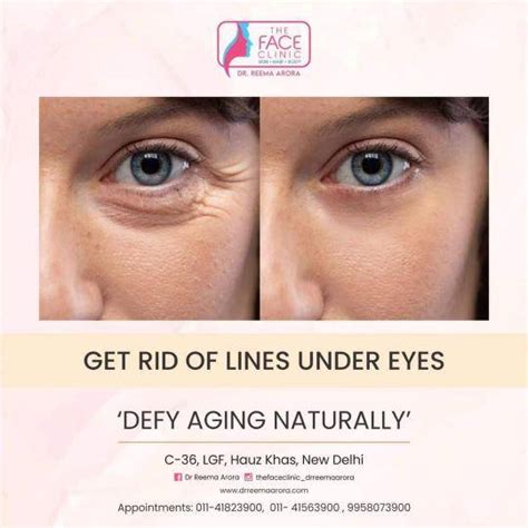 Non-Surgical Blepharoplasty in Delhi | Non-Surgical Eye Lid Lift Cost ...