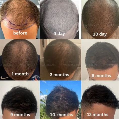 Hair Transplant Timeline Progress l 0 to 12 Months Photos