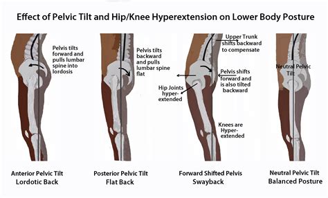 Effect of Pelvic Tilt and Hip/Knee Hyperextension on Lower Body Posture ...