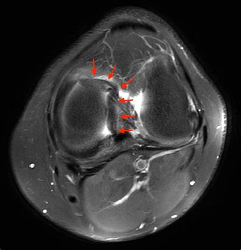 Bucket Handle Tear Of Medial Meniscus at Victor Bartlett blog