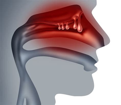 Mepolizumab Improves Loss of Smell in Chronic Rhinosinusitis With Nasal Polyps - Pulmonology Advisor