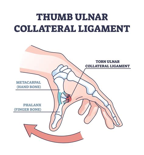 Ulnar Collateral Ligament Injuries of the Thumb - Physioflow PT ...