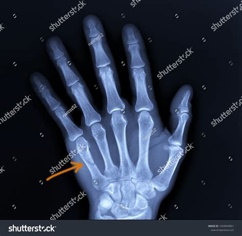 On Xray Hand Fracture Fifth Metacarpal Stock Photo 1543043891 ...