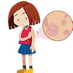 eczema
