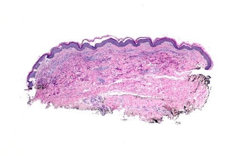 Dermal hypersensitivity reaction