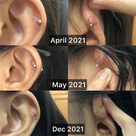 Keloid Piercing Cartilage