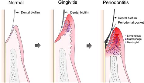 Dental Biofilm Definition at Evelyn Wegner blog