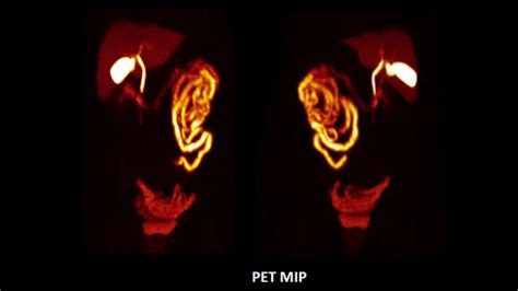 Biograph Vision PET/CT Scanner - Siemens Healthineers India