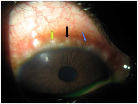 Immunopharmacology in Vernal Keratoconjunctivitis: Current and Future Perspectives