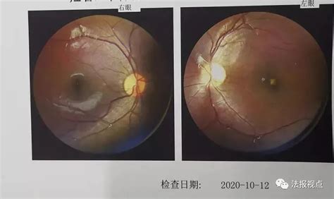 激光近视手术有后遗症吗？