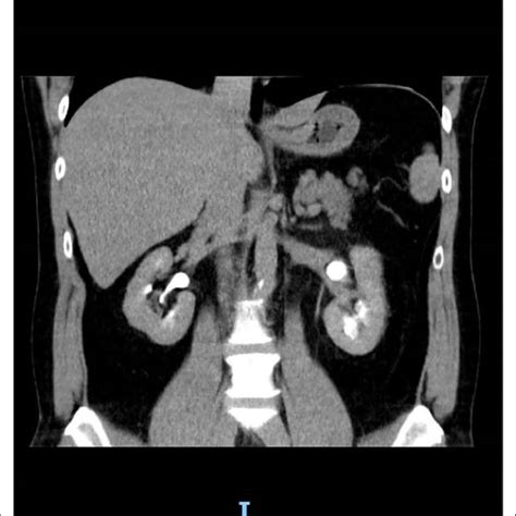 Kuvatulokset haulle parapelvic cyst kidney