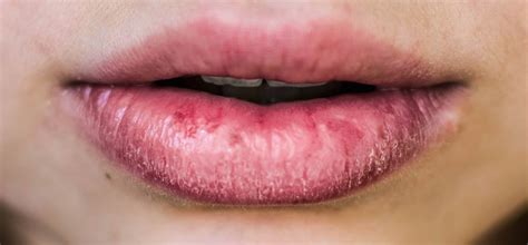 Eczema Mouth Ulcers at James Browning blog