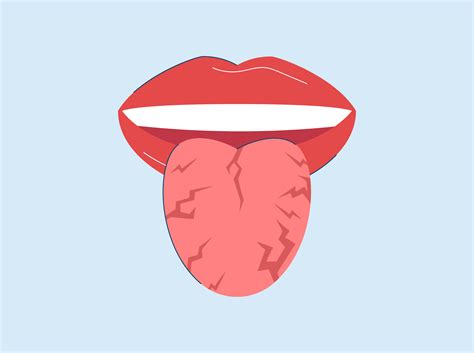 Why Is My Tongue Cracked? Causes, Symptoms, and Treatment Explained