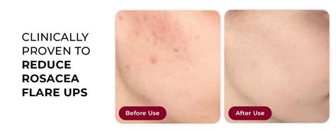 Shop Azicalm Redness & Inflammation Relief Cream | 10% Azelaic Acid for ...