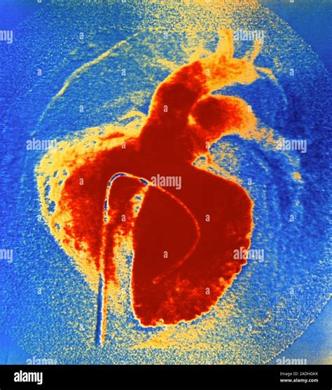 Congenital heart disease (hole in the heart). Angiogram of a ventricular septal defect. This is ...